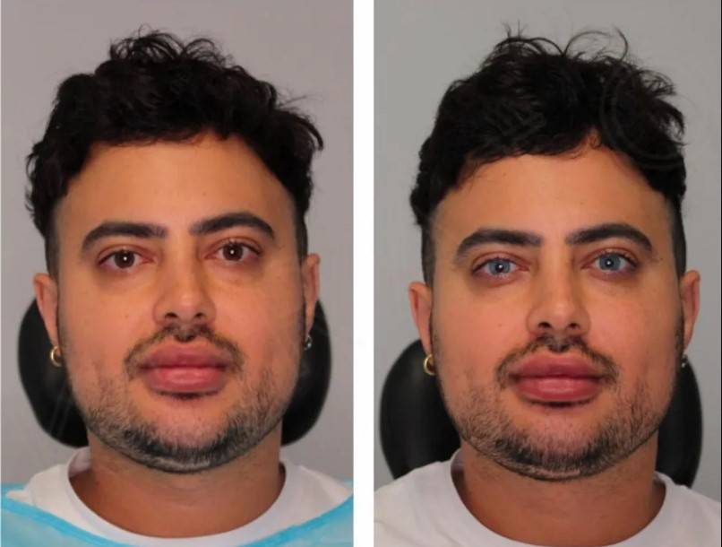 Homem faz procedimento para alterar cor dos olhos e viraliza; prática não é recomendada; VÍDEO