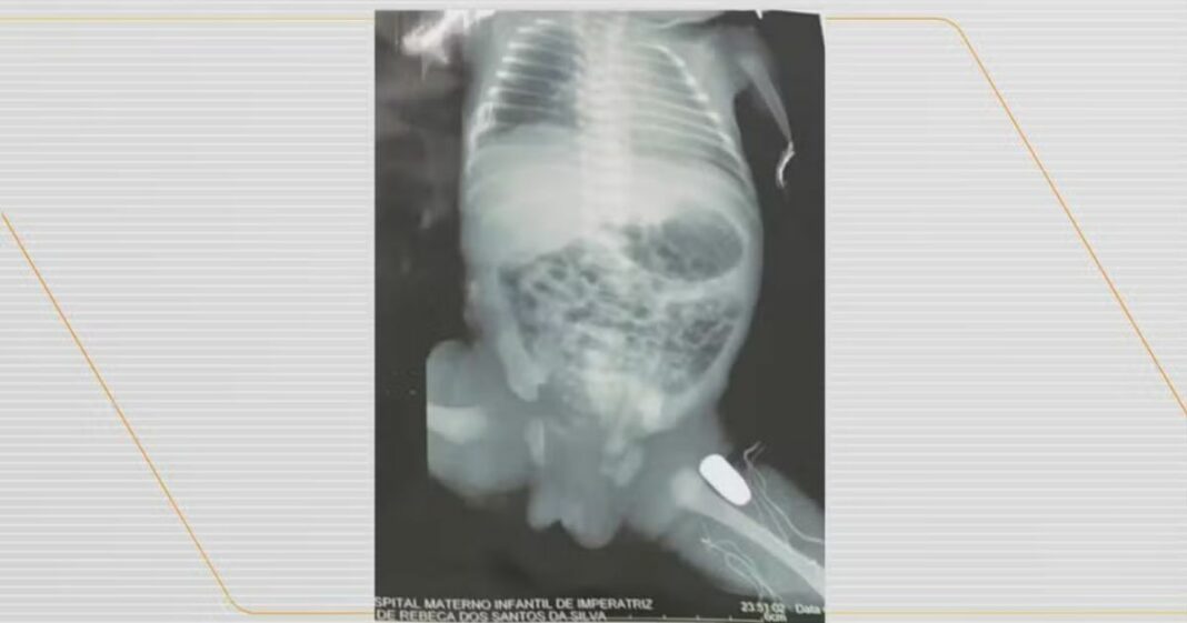 Bebê baleada dentro da barriga da mãe