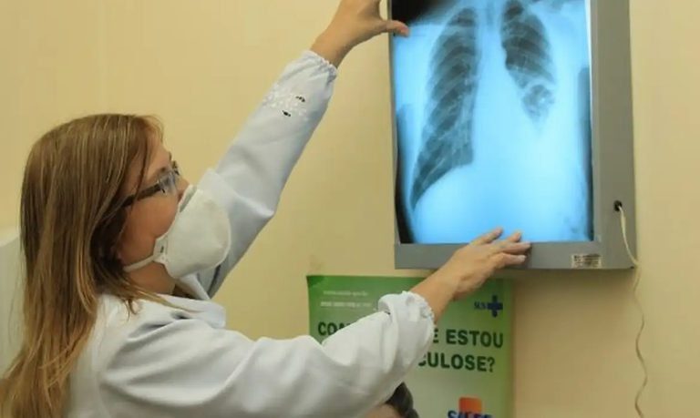 Brasil amplia prevenção e adota tratamentos inovadores para eliminar a tuberculose