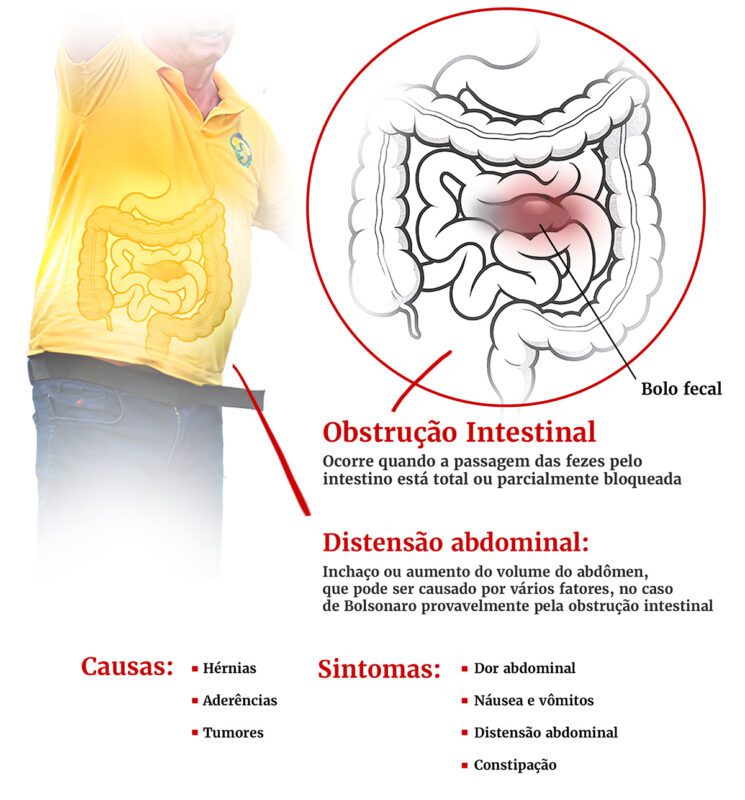 Família e médicos decidem permanência de Bolsonaro no hospital em RN