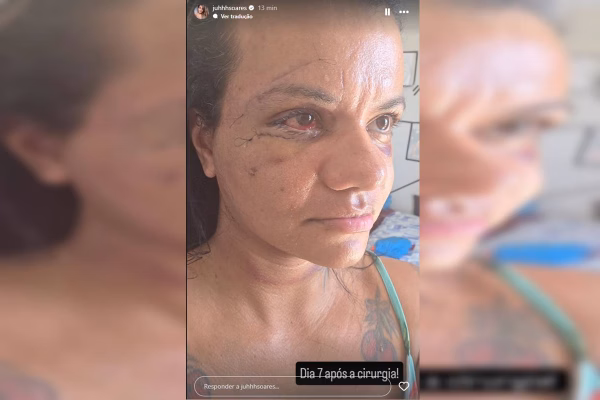 Mulher que levou 61 socos do ex mostra rotina e recuperação nas redes
